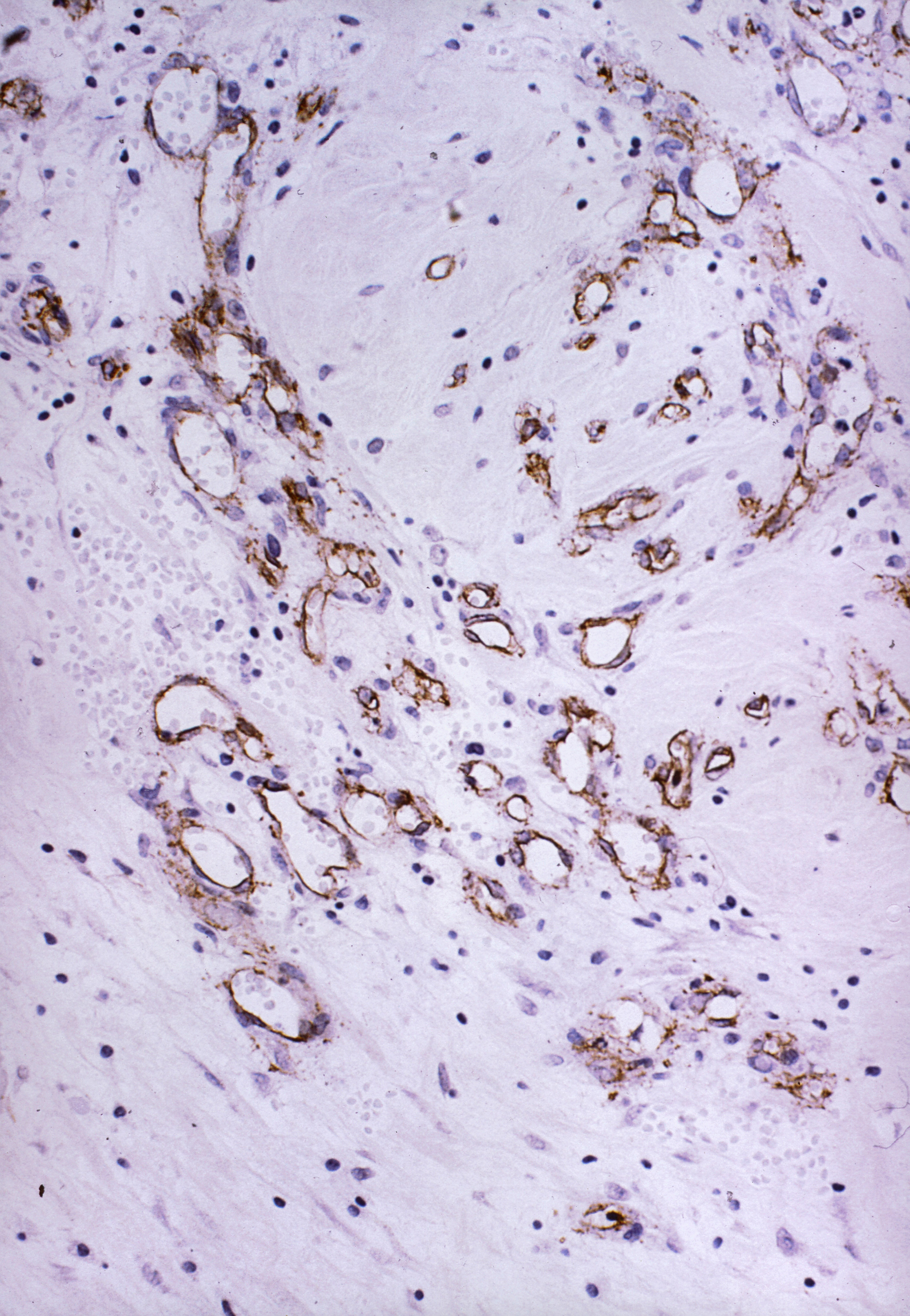Women treated for precursor of breast cancer can expect to live as long as other women