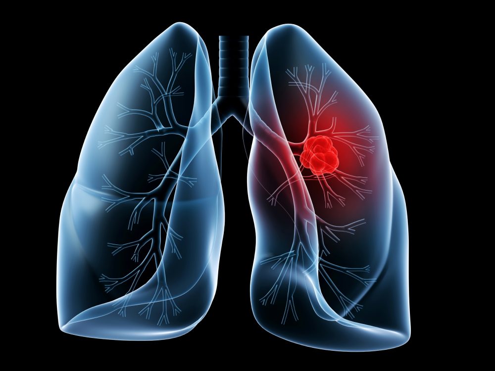 First-line therapy with TKIs in NSCLC