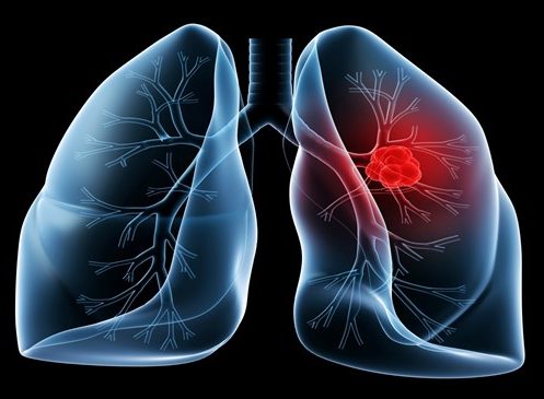 Further positive data published for lung cancer screening