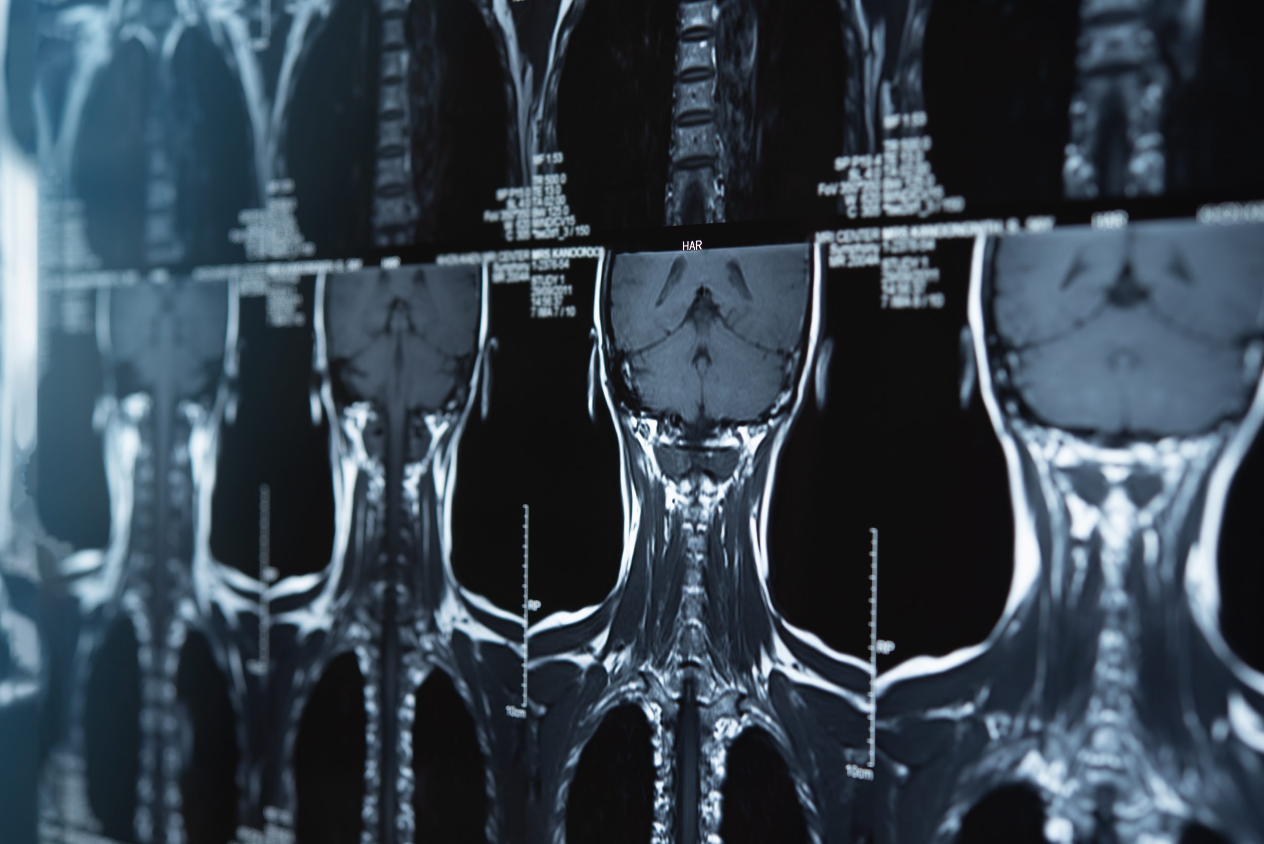 Head and neck cancer updates presented at ESMO 2020