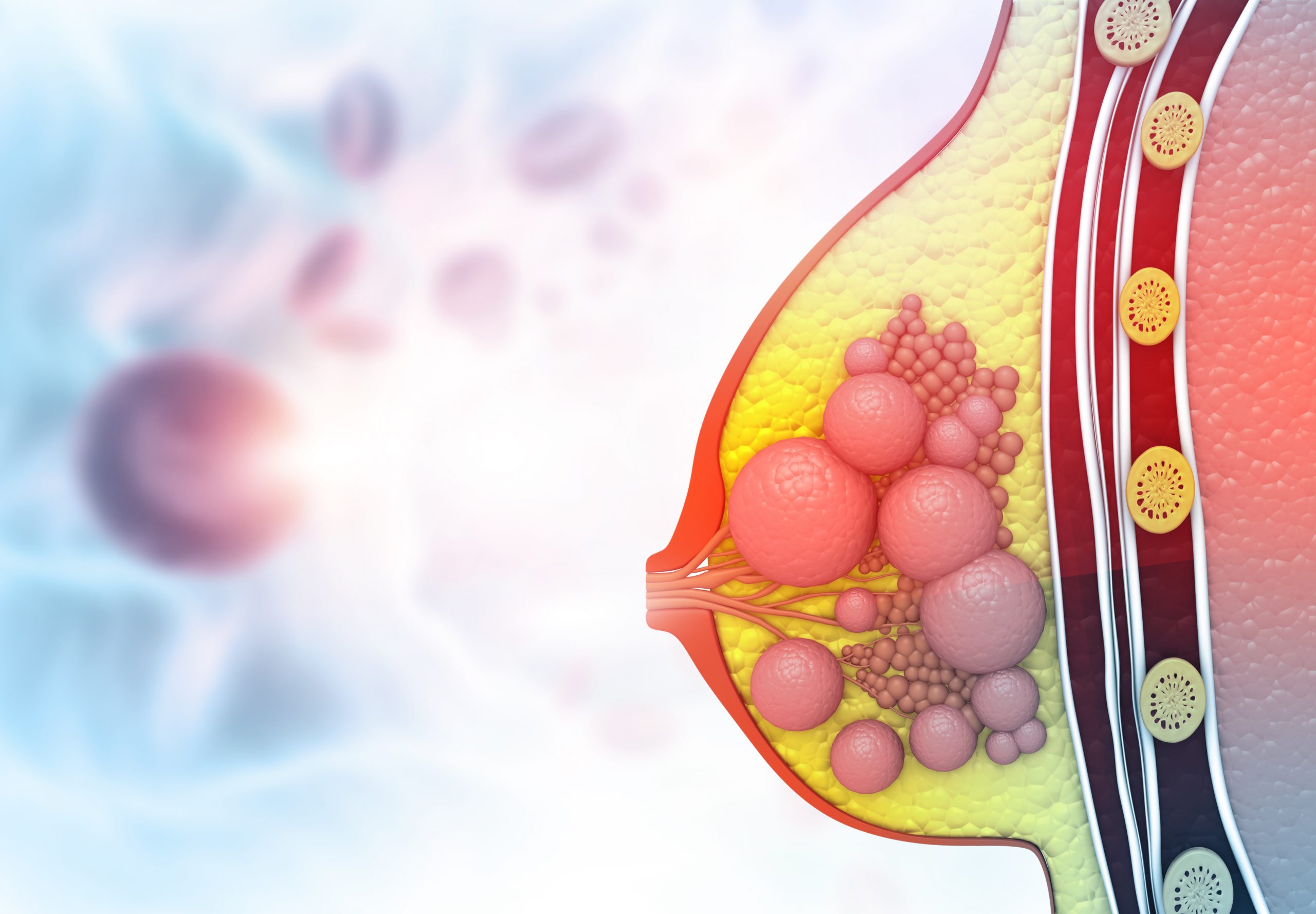 RxPONDER: sparing chemotherapy in post-menopausal patients with node-positive early-stage breast cancer