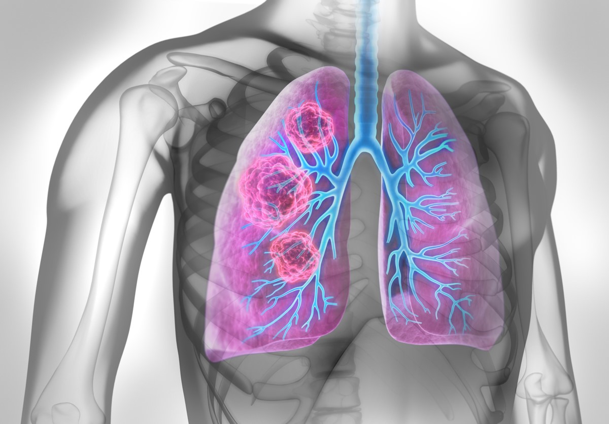 Lung Cancer