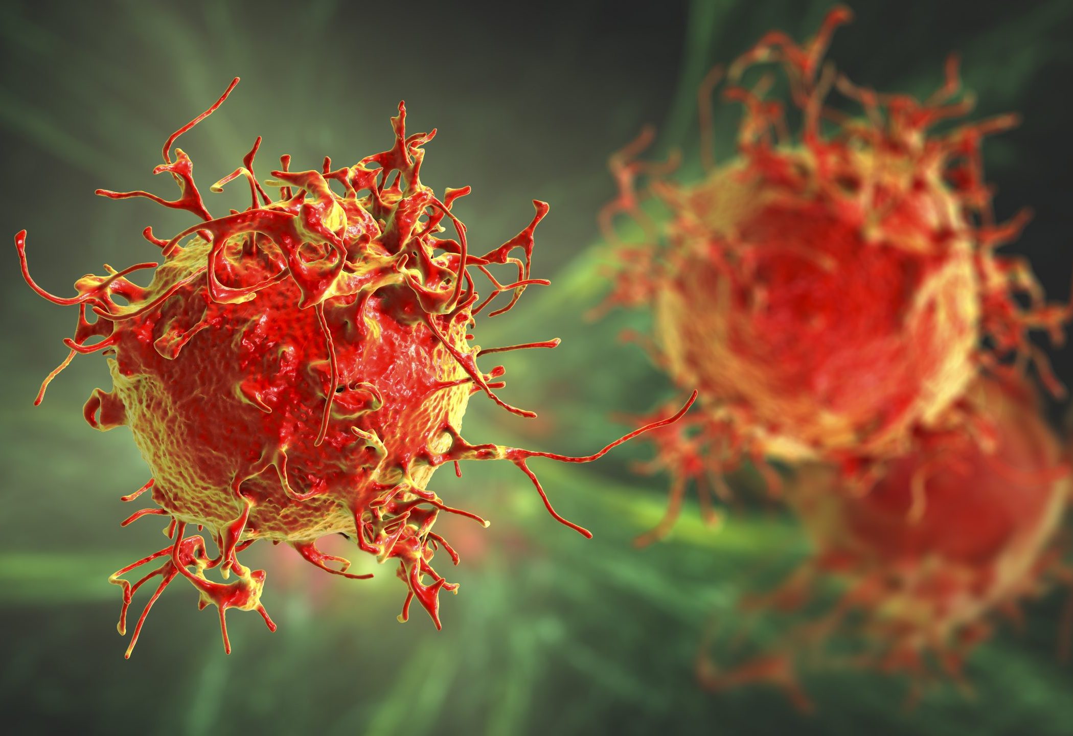 melanoma