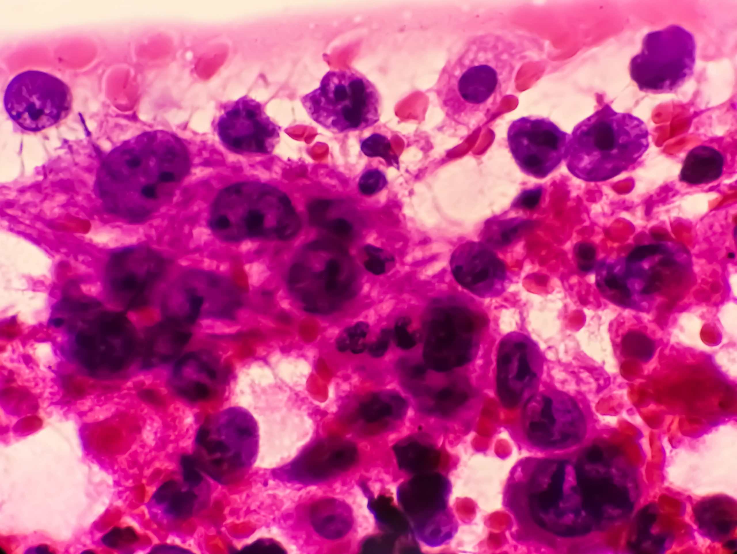 BTOG 2022: Highlights in lung cancer