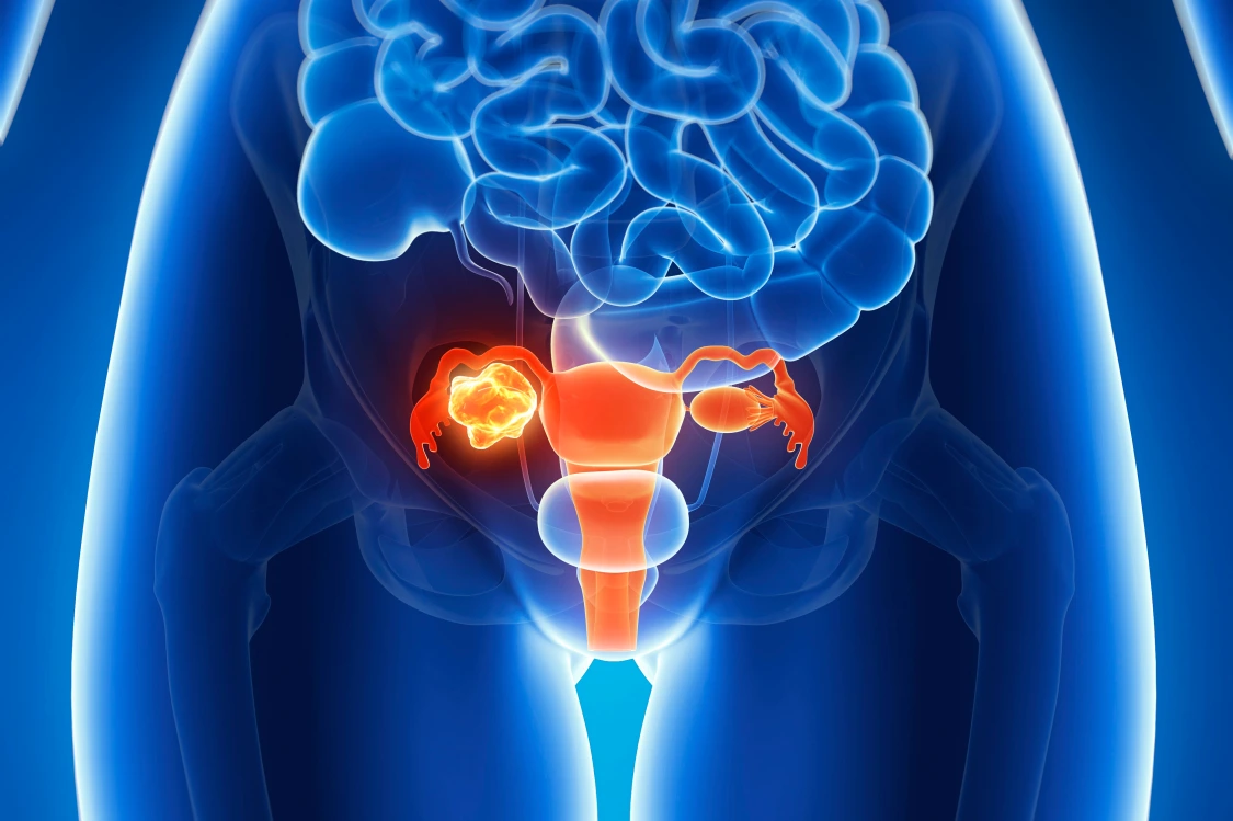 First-line maintenance with olaparib monotherapy and in combination bevacizumab increases survival in advanced ovarian cancer